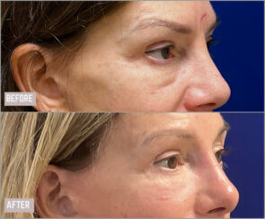 Revision facelift – Secondary facelift