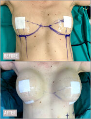 Breast augmentation and internal breast lift.
