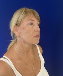 Facial Rejuvenation procedures.