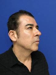 49-year-old male with moderate midface ptosis with skin laxity of the face.