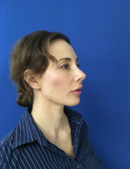 fat transfer to the following areas: under eyes, lips, chin and jawline.