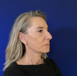 Face and Neck lifting procedures