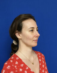fat transfer to the following areas: under eyes, lips, chin and jawline.