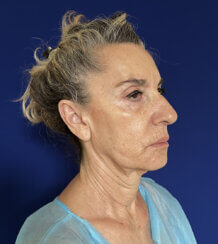 Face and Neck lifting procedures