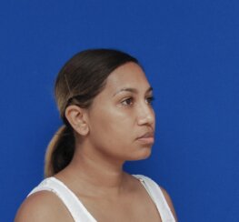 Minimally invasive midface suspension (MIMS)