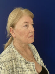 Facial Rejuvenation procedures.