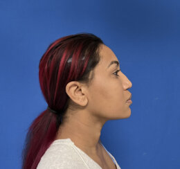 Minimally invasive midface suspension (MIMS)