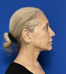 FaceLift and Upper Eyelid Surgery