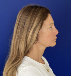 Revision facelift – Secondary facelift