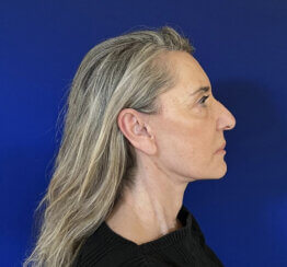 Face and Neck lifting procedures