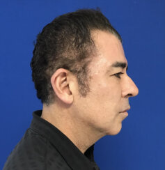 49-year-old male with moderate midface ptosis with skin laxity of the face.