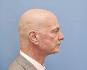 This gentleman had the following facelifting face lifting and neck lifting procedures