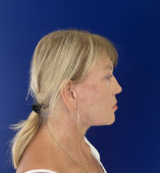 Facial Rejuvenation procedures.