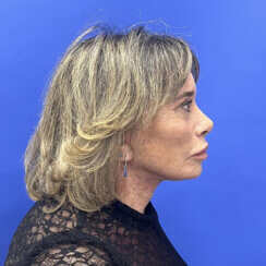 Revision facelift – Secondary facelift and associated face lifting procedures.