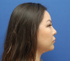 Endoscopic Brow Lift and Facelift