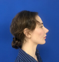 fat transfer to the following areas: under eyes, lips, chin and jawline.