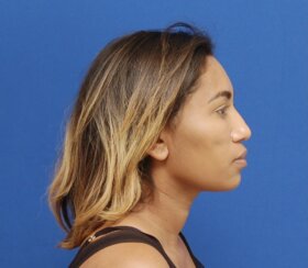 Minimally invasive midface suspension (MIMS)