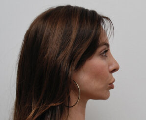 Endoscopic browlift
