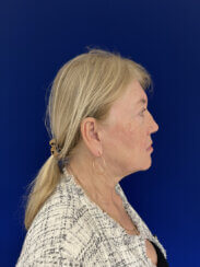Facial Rejuvenation procedures.