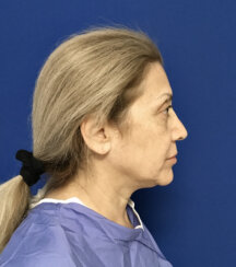FaceLift and Upper Eyelid Surgery