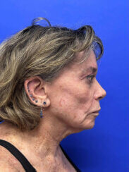 Revision facelift – Secondary facelift and associated face lifting procedures.