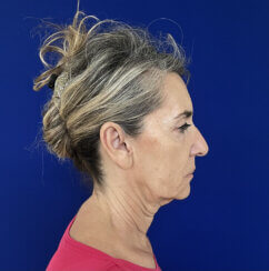 Face and Neck lifting procedures