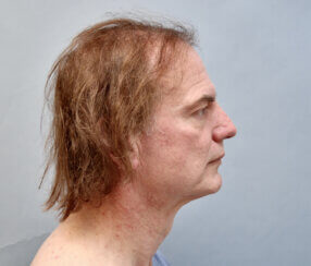 This gentleman had the following facelifting face lifting and neck lifting procedures