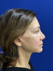 Revision facelift – Secondary facelift