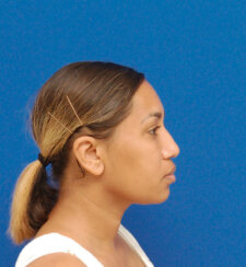 Minimally invasive midface suspension (MIMS)