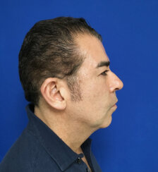 49-year-old male with moderate midface ptosis with skin laxity of the face.