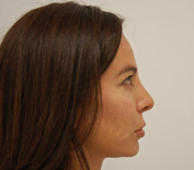 Endoscopic browlift