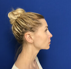 Beautiful 39-year-old lady with minor midface ptosis and minor skin laxity.