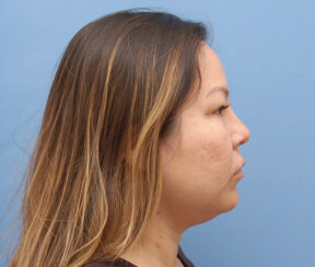Endoscopic Brow Lift and Facelift