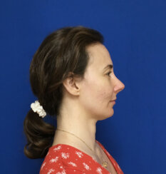 fat transfer to the following areas: under eyes, lips, chin and jawline.
