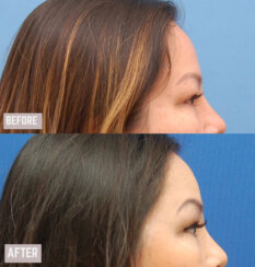 Endoscopic Brow Lift and Facelift