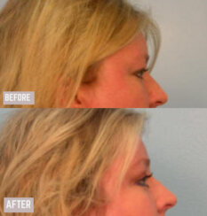 Endoscopic Brow Lift, Endoscopic Forehead Lift and Necklift