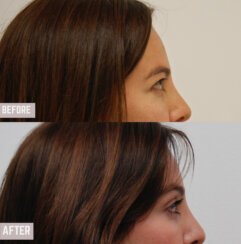 Endoscopic browlift