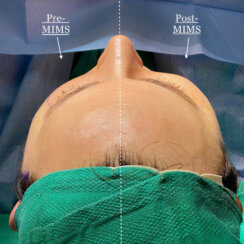 fat transfer to the following areas: under eyes, lips, chin and jawline.